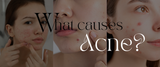 What Causes Acne and How to Fix It?